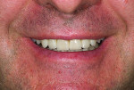 Fig 19. Patient's smile with completed restorations bonded and the posterior teeth equilibrated.