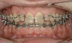 Fig 7. Orthodontic endpoint; note the spaces created to allow for equilibration and restorative material.