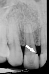 Figure 2  Radiograph shows a defect at the mesial crown margin of tooth No. 10.