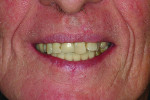 Fig 23. The well-supported lip and mandibular restoration.