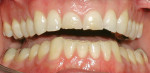 Figure 7  As the lingual surfaces of the maxillary anterior teeth wore, the mandibular incisor teeth erupted, resulting in an uneven plane of occlusion in the mandible.