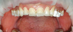 Figure 15  The palatal veneers bonded to place and isolated by an OptraGate. Note the amount of edge lengthening.