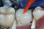 Matrices placed and secured with wooden wedges, two increments of ACTIVA Restorative injected, and photopolymerized.