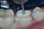 Occlusal and mesial tooth preparation in progress.