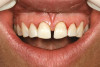 2. Side-by-side restorations placed with bulk-fill composite (Aura Bulk Fill, SDI) prior to removal of the sectional matrix on the distal aspect of tooth No. 12. A sectional matrix was first placed on the mesial aspect of tooth No. 13 and the restorative material placed and contoured prior to filling the preparation on tooth No. 12.