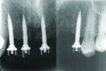 Fig 6 and Fig 7. Post-placement radiographs of four NDIs.