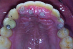 Fig 8. NDIs supporting the fixed provisional with access holes filled with resin.