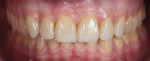 Fig 26. Intraoral photograph of the patient at 1.5-year recall showing stable treatment outcome.