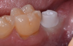 Zirconia abutment after final torquing to 35 ncm with teflon sealed access.