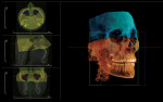 Figure 4  Stitching two CBCT data sets using InVivoDental third-party software. Images are imported DICOM files.