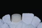 Fig 14 through Fig 17. IPS e.max Ceram Deep Dentine powder is used according to the “salt-and-pepper” technique to opacify the coping, as well as contribute to light reflection.