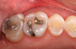 Figure 1  Preoperative condition of the upper right molar teeth.