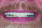 Fig 11. Close-up smile with temporaries fabricated from wax-up.