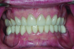 Fig 15. Post-treatment close-up with teeth in MIP.