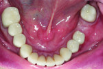 Fig 17. Post-treatment mandibular view