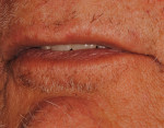 Fig 9. Maxillary incisors contacting just lingual to the wet-dry line.