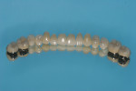 The 14 completed maxillary restorations.