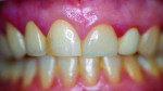 Fig 1. Preoperative view of the patient’s dentition.