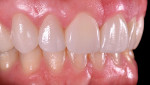 Fig 12 through Fig 14. The final result of the KATANA zirconia UTML crowns.