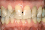 Figure 1  A preoperative evaluation reveals the patient’s open diastema. The lateral was fractured incisally, and there was discoloration throughout.