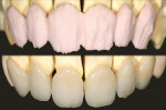 Figure 5A and Figure 5B  GC Initial™ porcelain was applied as a first dentin layer. After the first bake, chroma and incisal porcelain was applied.
