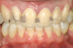 Figure 9: Preoperatively, the patient had discoloration, an open diastema, fracture, and an unesthetic appearance. To demonstrate the new and improved emergence of the dentition, the technician used a computer program to shade the affected areas in the po