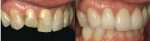 Figure 10  Right side before-and-after views, postcementation.