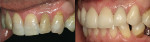 Figure 11  Left side before-and-after views, post-cementation.