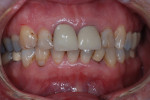 Fig 1. A 61-year-old female patient was referred for evaluation of periodontitis.