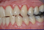 Fig 9. Female patient with mild–moderate periodontitis (Fig 7 through Fig 9).