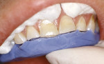 Figure 2  A putty guide made from a diagnostic wax-up is used to establish incisal length.