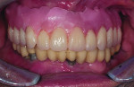 Fig 8. After the cast was mounted on a semi-adjustable articulator, the teeth were set up and tried in the patient’s mouth to assess
phonetics and esthetics and obtain patient approval.