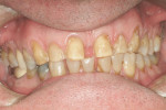 Figure 6  Teeth were prepared for porcelain veneers to improve appearance and close spaces.