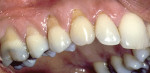 Figure 8  Thin tissue biotype, bruxing, and toothbrush abrasion contributing to areas at the gingival margin that exhibited sensitivity to cold. Notice crack lines in the molar.