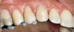 Figure 9: Teeth Nos. 3 through 6 were restored with composite resin to eliminate sensitivity.