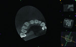 Fig 3. Measurement on the CBCT radiograph suggested only 4.4 mm was present between the teeth to place the dental implant.