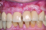 10. Clinical view of the anterior region 6 years later. A midline diastema had opened between the right central incisor and the implant replacing the left central incisor. In addition, the implants appeared to both be more apical to the adjacent dentition and have a slight labial
angulation. The calcium channel blocker-associated
hyperplasia had also increased.