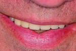 Fig 7. Smile of a 59-year-old male patient at the completion of prosthetic work done in the maxillary anterior. His smile covered most of the teeth, avoiding display of the gingival frame.