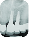 Fig 9. Radiograph exposed at the time of implant restoration. An angled vertical crest remained between the right central incisor and the adjacent implant.