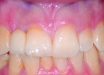 5. Anterior view of the implant-supported single crown at the maxillary right lateral incisor.
