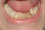 Figure 16  The patient was unhappy with the appearance of her lower anterior teeth because of crowding and discoloration.
