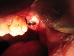 Implant at time of surgery.