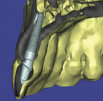 Figure 3  CT scan and Materialise planning software was used to accurately plan the use of a one-piece Zimmer Unibody dental implant to replace congenitally missing tooth No. 10.