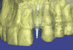 Figure 5  SimPlant software was used to precisely plan the placement of the Unibody implant.