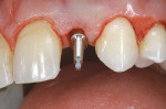 Figure 8  Straight analog test after the pilot drill provided verification before the final drilling and insertion of the Unibody implant.