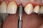 Figure 9  Straight analog test after the pilot drill provided verification before the final drilling and insertion of the Unibody implant.