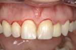 Figure 12  The immediate non-occlusal loaded temporary at day 1 of the combined implant and crown-lengthening surgery and 1 week post-operatively. Note the excellent healing and esthetics.