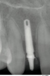 Figure 15  The 3-month radiograph and clinical photograph. Note the bone preservation at the crest.