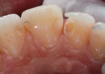 A minimal tooth preparation was done on tooth No. 10 to preserve the integrity of the lateral
incisor.