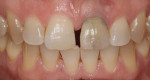 An enameloplasty was completed on teeth Nos. 8 and 9 until the incisal edge length was acceptable to the patient.